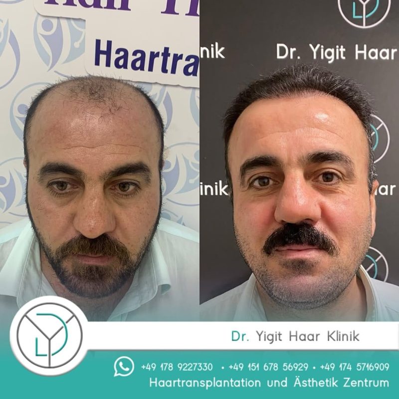 Before After