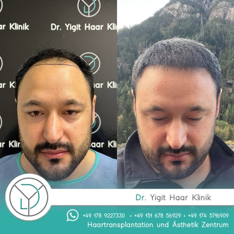 Before After