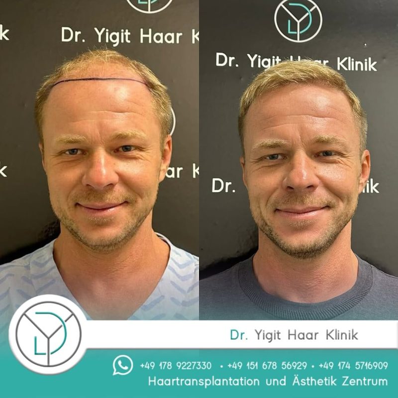 Before After