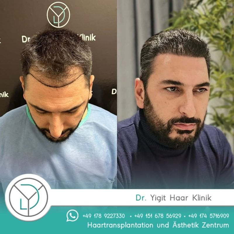 Before After