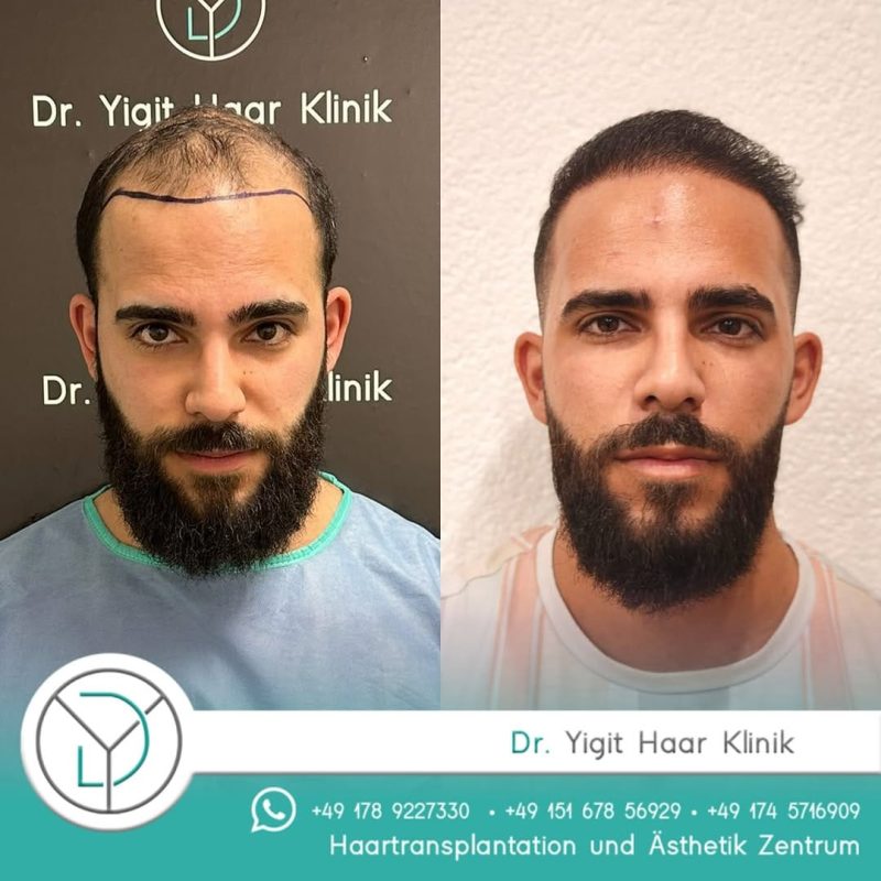 Before After