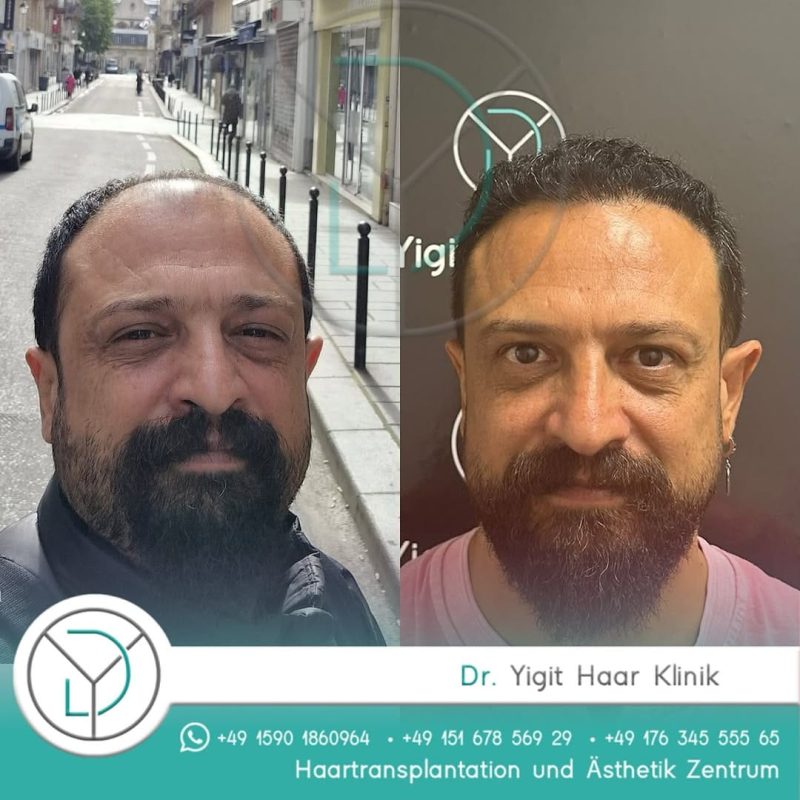 Before After