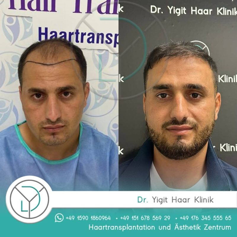 Before After