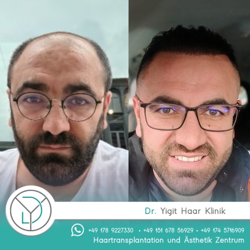 before after haartransplantation
