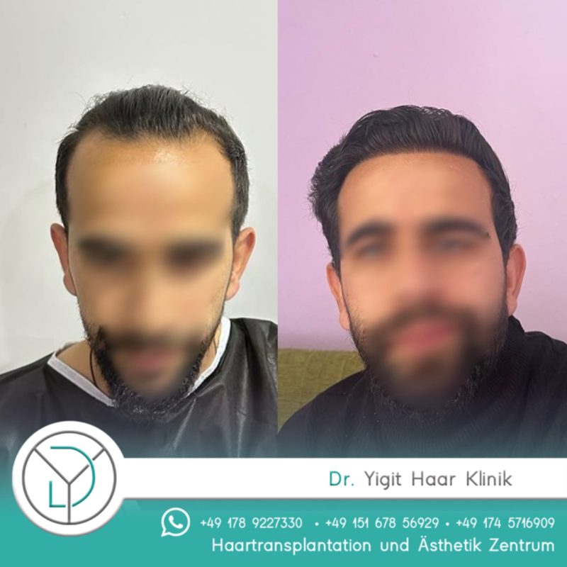 before after haartransplantation