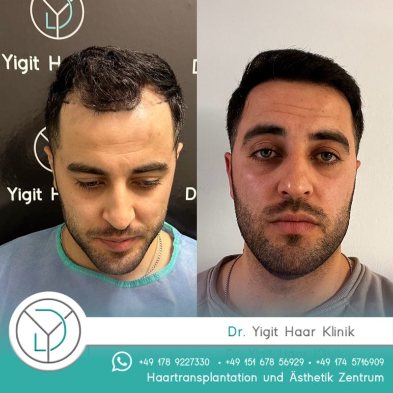 before after haartransplantation